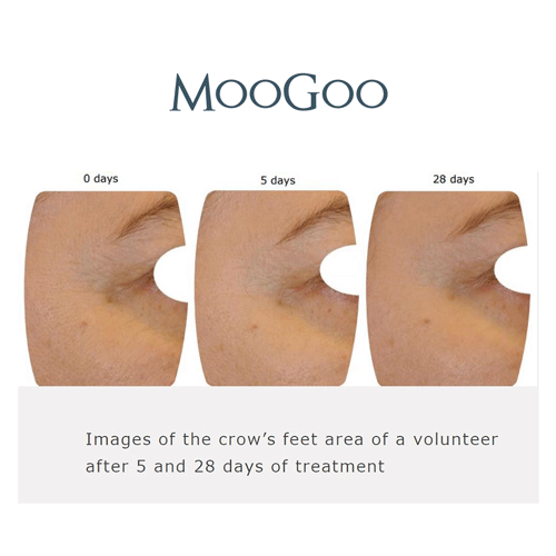 Images of the crow's feet area of a volunteer after 5 and 28 days of treatment using MooGoo's Amplified Anti-Ageing Peptide Active Serum 25ml. Expression lines reduced and diminished, the skin is tightened.