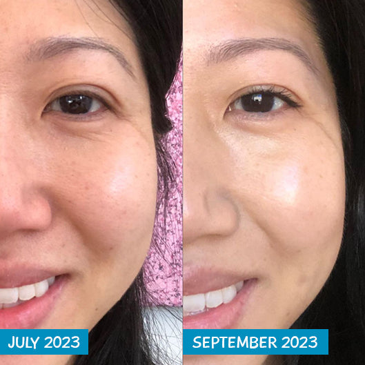 Before and after photo of a woman's face showing the effect MooGoo's Amplified Anti-Ageing Peptide Active Serum 25ml has on the face. her skin roughness, radiance, firmness, elasticity, and facial volume is improved.