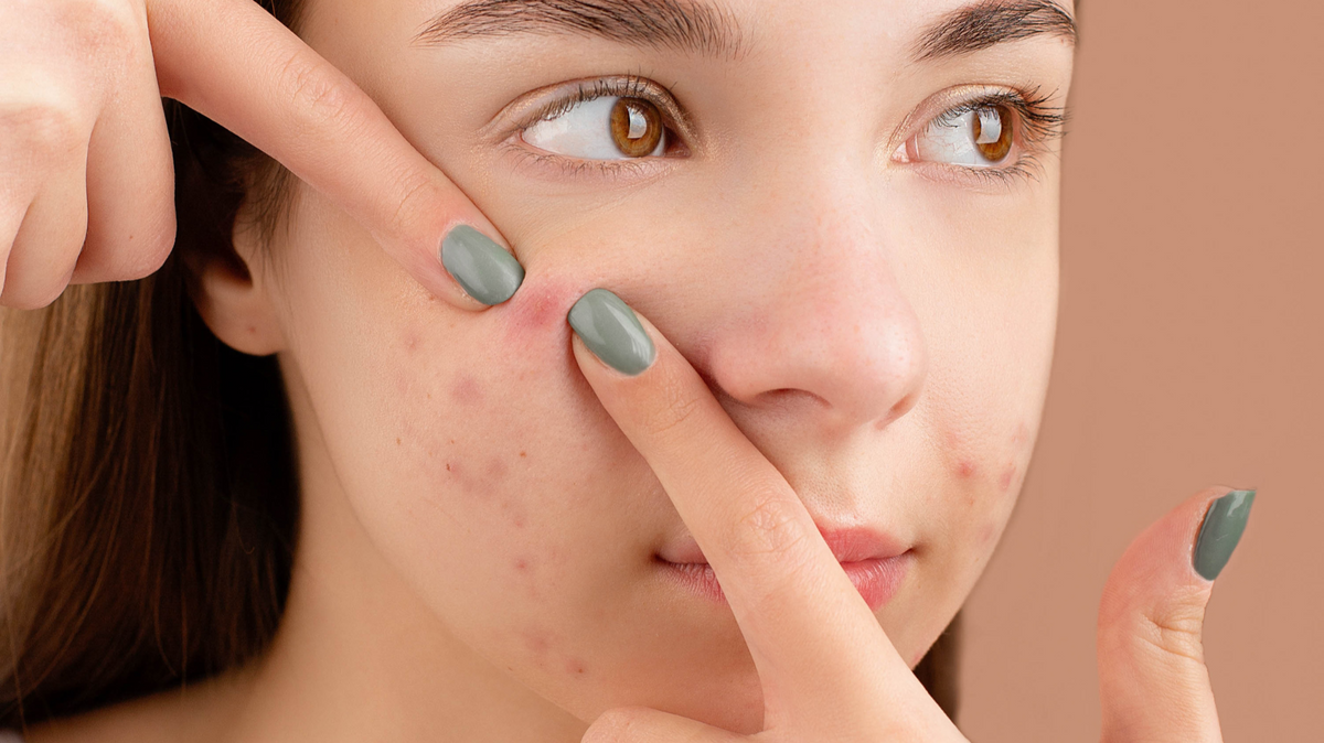 Adult squeezing a facial pimple on the cheek