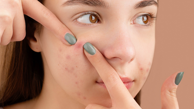 What Causes Pimples In Adults? Which Natural Skincare Ingredients Help?