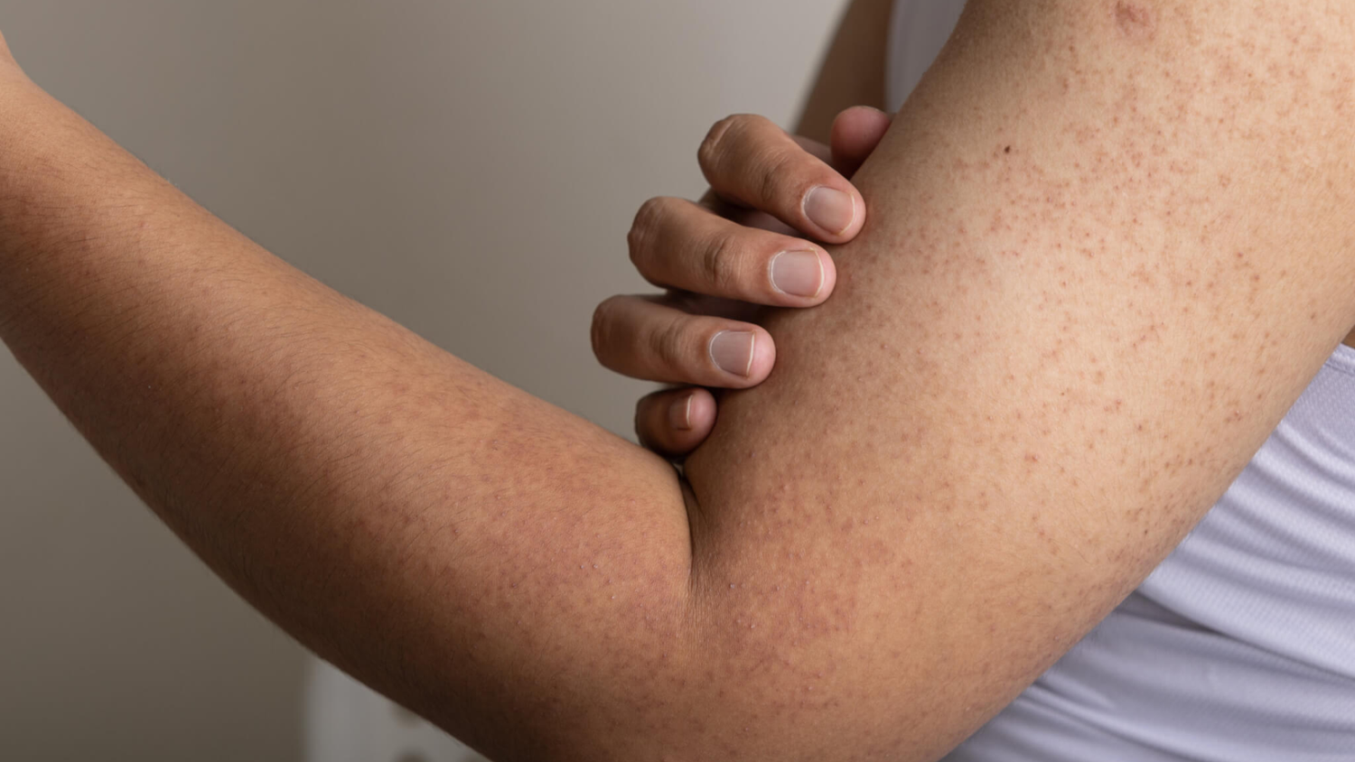 What Is Keratosis Pilaris And How To Treat It Naturally? – MooGoo AU