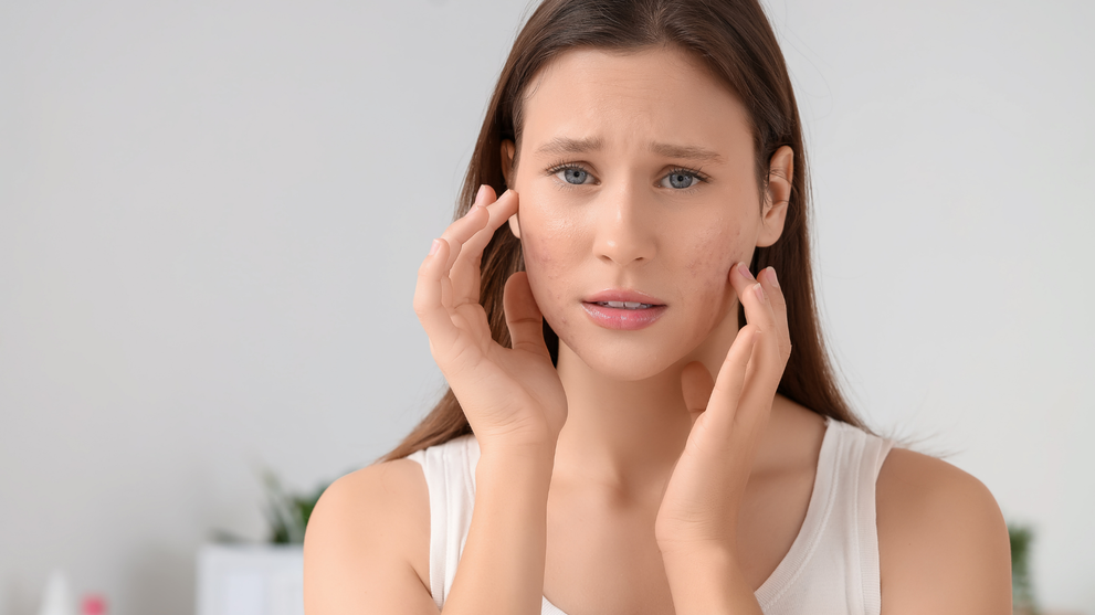 Rosacea Skincare