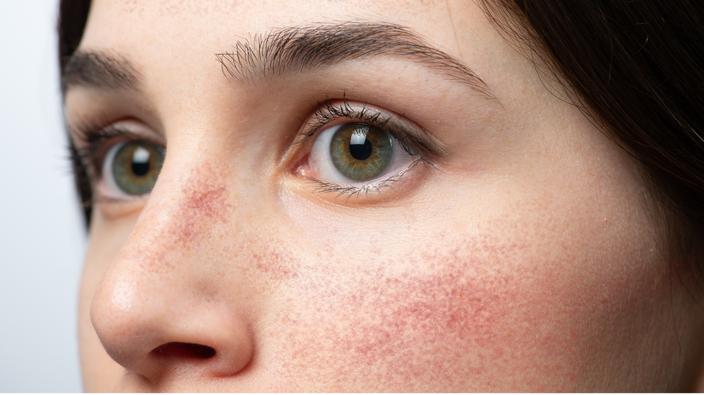 Topical Steroid Withdrawal