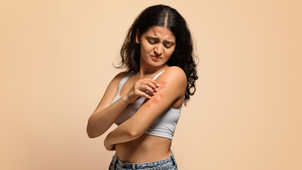 What Are The Benefits Of Using Natural Treatments For Psoriasis