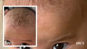 Why Is My Dandruff Persistent Despite Using Different Treatments