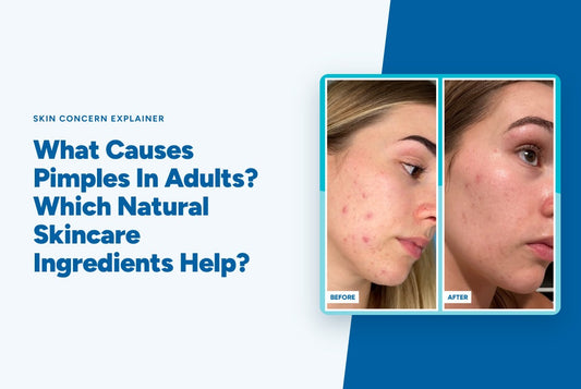 What Causes Pimples In Adults? Which Natural Skincare Ingredients Help?