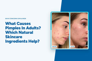 What Causes Pimples In Adults? Which Natural Skincare Ingredients Help?