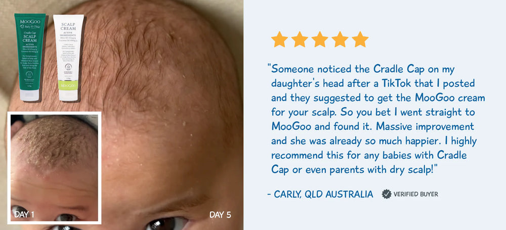 Seborrheic Dermatitis