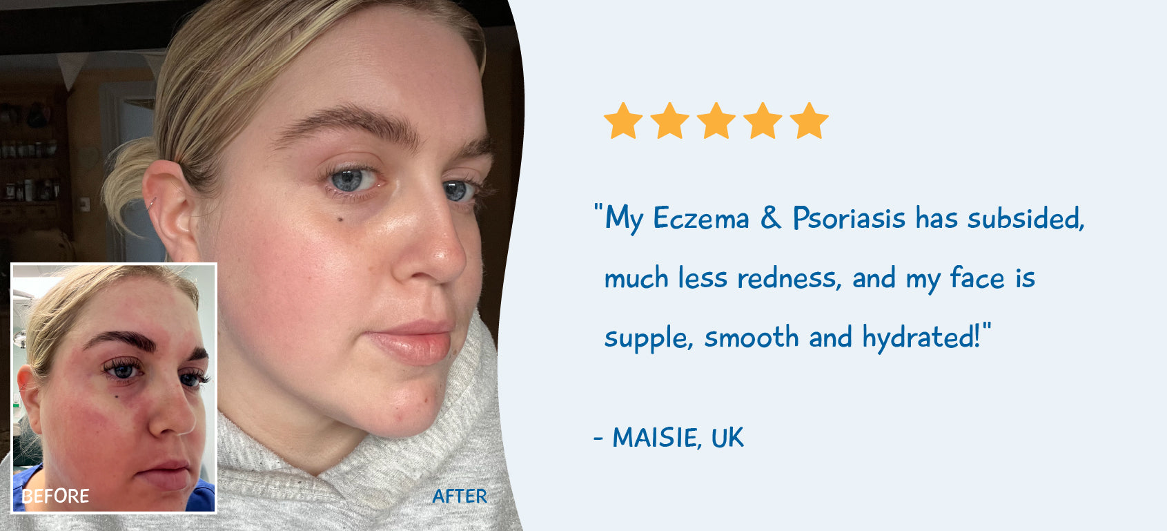 Eczema & Psoriasis