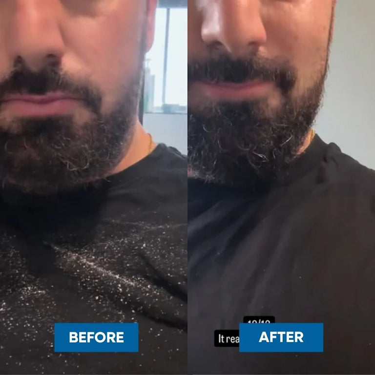 A side-by-side before and after comparison of a man's beard, showing less flakes on his shirt after using the MooGoo Flake Free Anti-Dandruff Shampoo. 