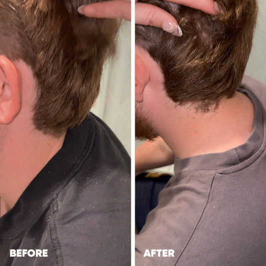 Customer with a head and shoulders before and after in a GIF, scratching the head and scalp to show visible results and reduction in flakes after using the MooGoo Flake Free Shampoo and Conditioner duo and Scalp Repair Cream