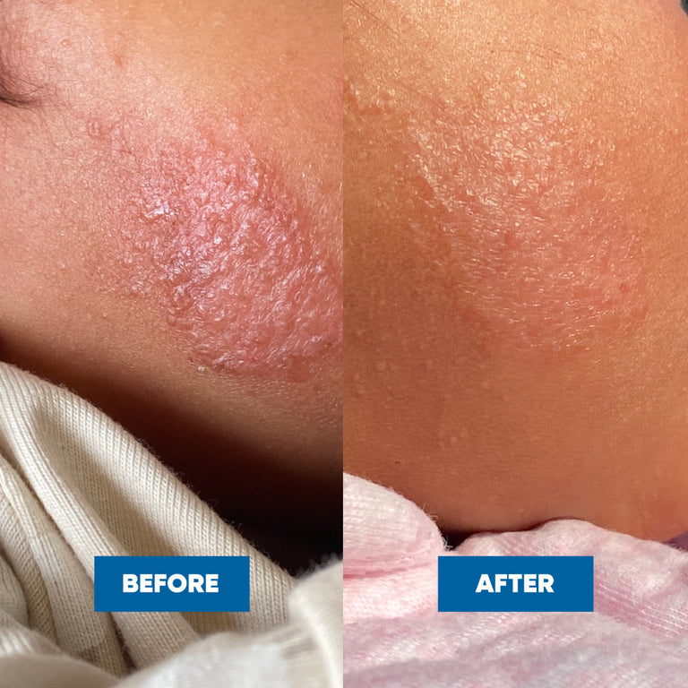 Before and after comparison of a child's cheek, showing eczema skin condition improvement after sing the Eczema & Psoriasis Cream.