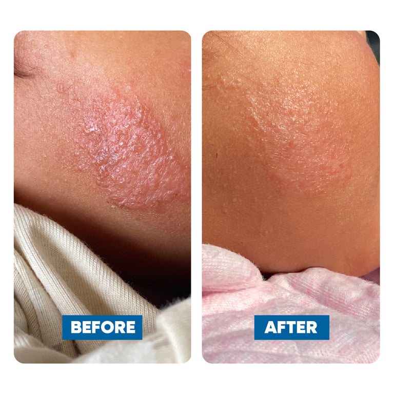 Before and after comparison of a child's cheek, showing eczema skin condition improvement.
