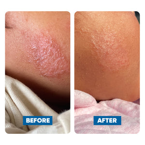 Before and after comparison of a child's cheek, showing eczema skin condition improvement.