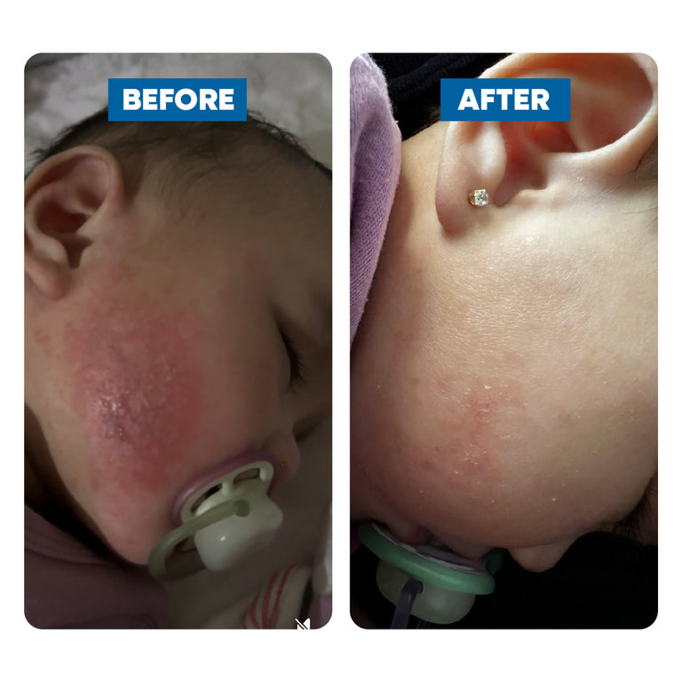 Before and after comparison of a child's cheek, showing eczema skin condition improvement.