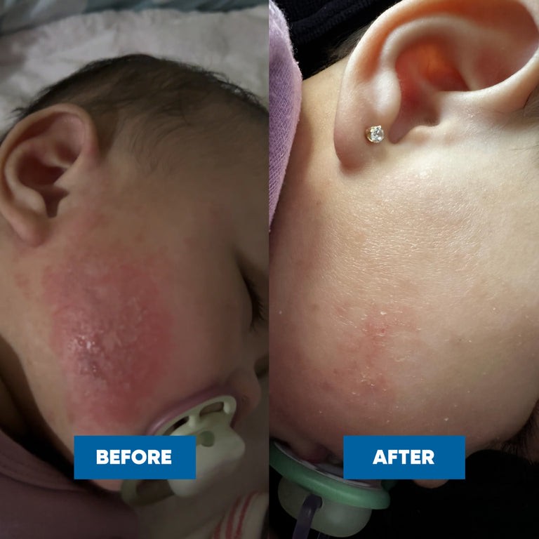 Before and after comparison of a child's cheek, showing eczema skin condition improvement after sing the Eczema & Psoriasis Cream.