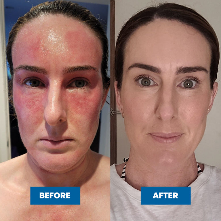 Before and after comparison of a woman's face, showing eczema skin condition improvement after using the Eczema & Psoriasis Cream.