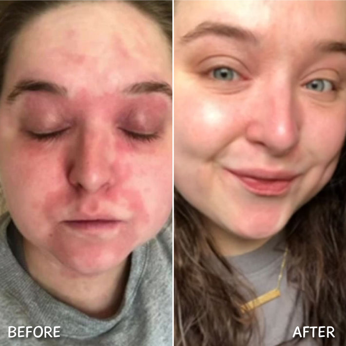 Breaking Down Eczema & Sensitive Skin – MooGoo AU