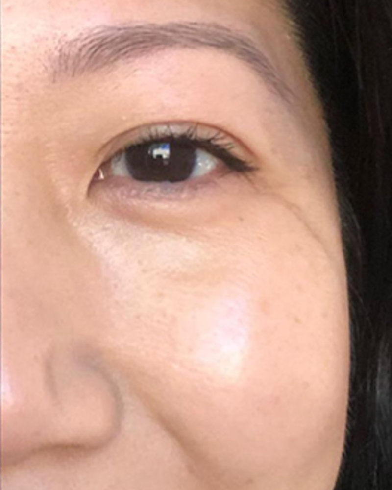 After using Argireline Amplified Peptide Serum