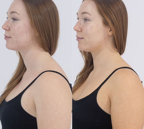 Before and after 24 hours using Tanning Mousse, profile