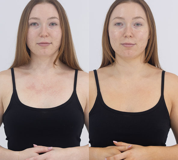 Customer before and 24 hours after one application of MooGoo Tanning Mousse