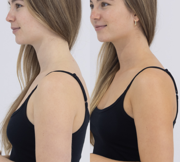 Customer side view before and 24 hours after MooGoo Tanning Water